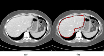 Automated CT Liver Volumetry by Use of Three-Dimensional Fast-Marching and Level-Set Segmentation