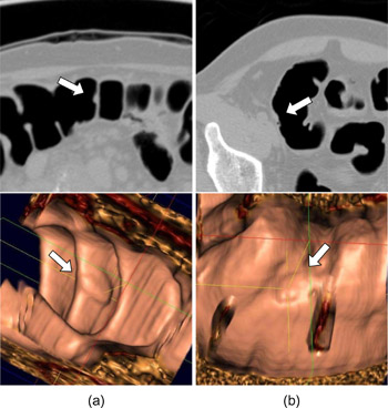 A CAD Utilizing 3D Massive-Training ANNs for Detection of Flat Lesions in CT Colonography in a Large Multicenter Clinical Trial