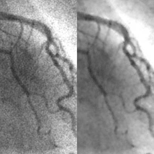 Reduction of Quantum Noise and Radiation Dose in Coronary Angiography by Means of a Neural Filter