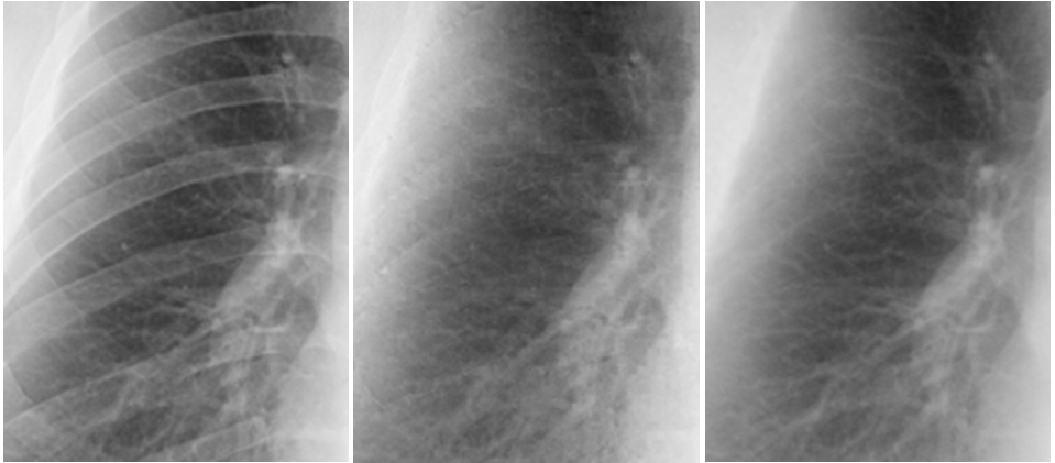 Improving the Conspicuity of Nodules in Chest Radiographs by Use of Virtual Dual-Energy Radiography