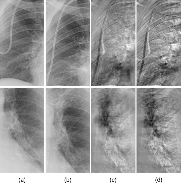 Enhanced Digital Chest Radiography: Temporal Subtraction Combined with Virtual Dual-EnergyETechnology for Improved Conspicuity of Growing Cancers and Other Pathologic Changes