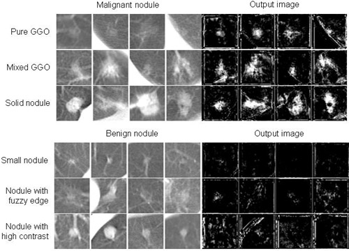Computer-aided Diagnostic Scheme for Distinction between Benign and Malignant Nodules in Thoracic Low-Dose CT by Use of a Massive-Training Artificial Neural Network