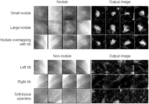 False-Positive Reduction in Computer-Aided Diagnostic Scheme for Detection of Nodules on Chest Radiographs by Means of Massive-Training Artificial Neural Network (MTANN)