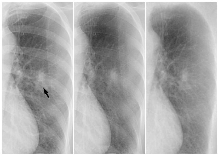 Improving the Conspicuity of Nodules in Chest Radiographs by Use of Virtual Dual-Energy Radiography