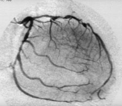 Robust Algorithm for Tracing Vessels in Coronary Angiography